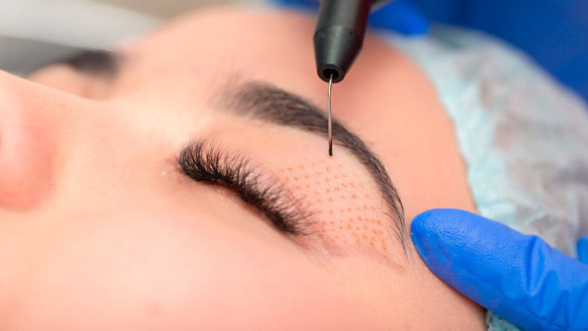 Plasma Pen Technician